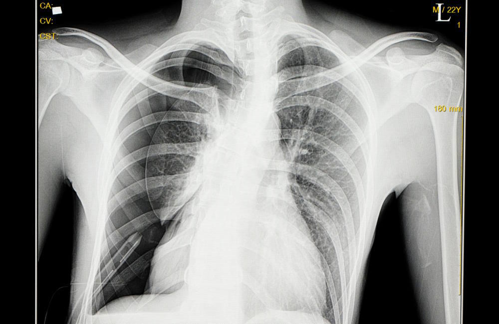 Can You Fly With A Collapsed Lung Travel With Pneumothorax 